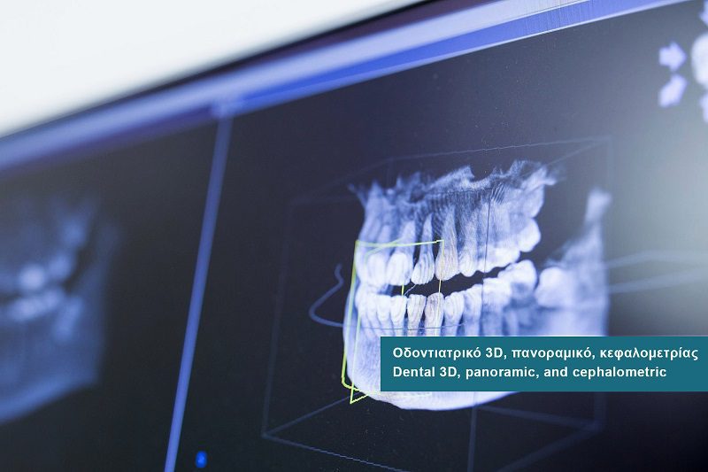 Dental 3D Xray