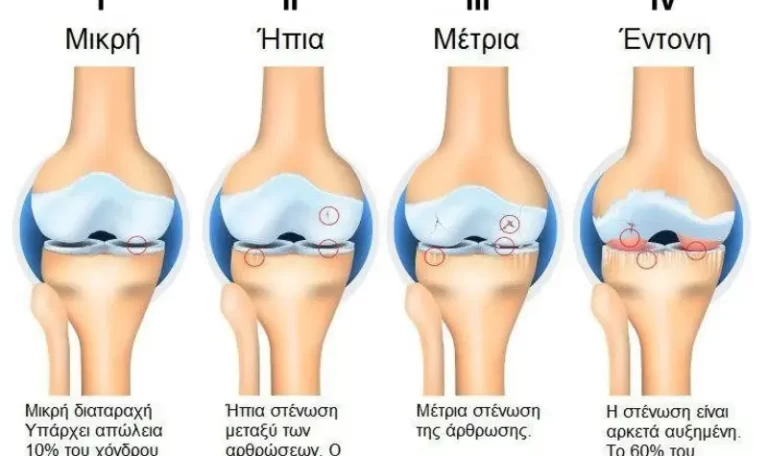 Knee Osteoarthritis Stages / Στάδια Οστεοαρθρίτιδας γονάτου