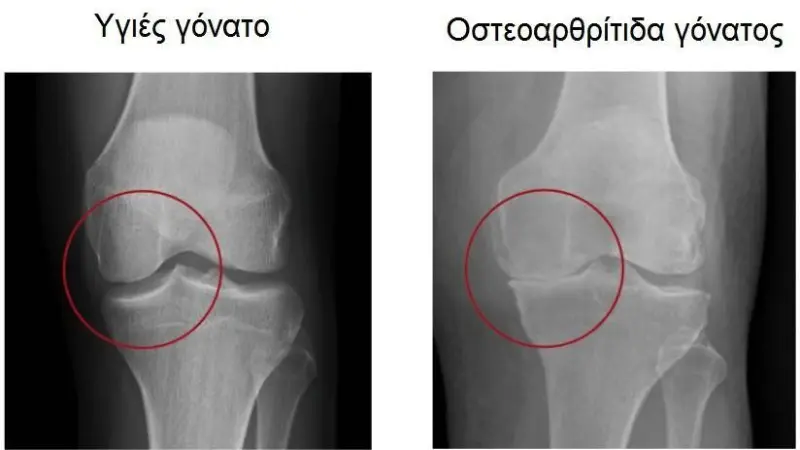 Knee Osteoarthritis / Οστεοαρθρίτιδα - πάθηση που επηρεάζει τις αρθρώσεις