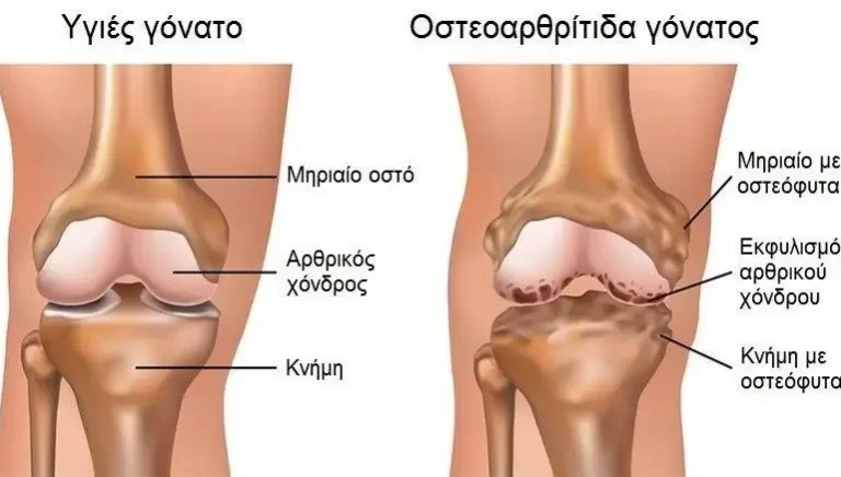 Knee Osteoarthritis- further explained / Περαιτέρω επεξήγηση Οστεοαρθρίτιδας γονάτου