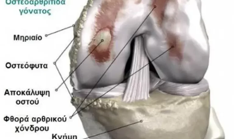 Knee Osteoarthritis: Explanation and relevance / Επεξήγηση Οστεοαρθρίτιδας γονάτου
