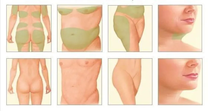 Liposuction and Tumescent technique / Λιποαναρρόφηση και η Τεχνική της Διογκωτικής Αναισθησίας (Tumescent)