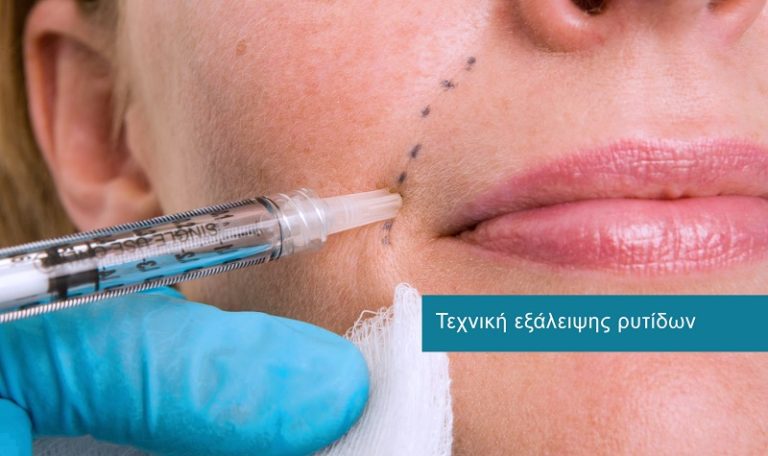 Treating Wrinkles Treating Wrinkles