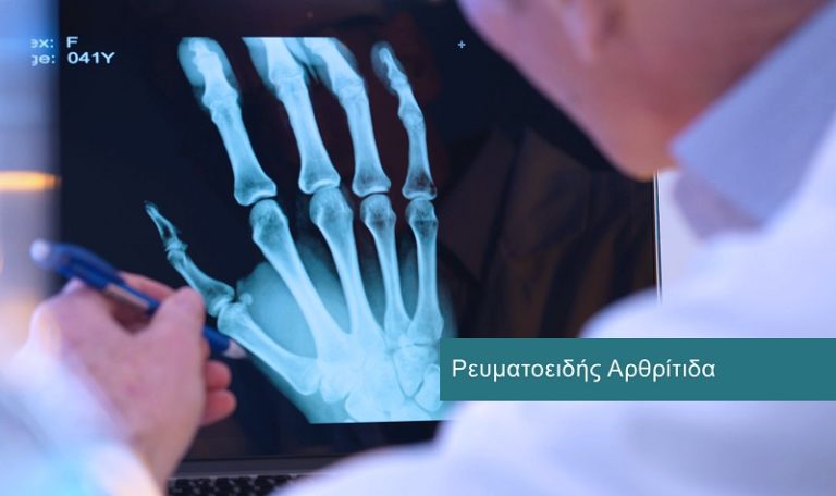 Ρευματοειδής Αρθρίτιδα Ρευματοειδής Αρθρίτιδα
