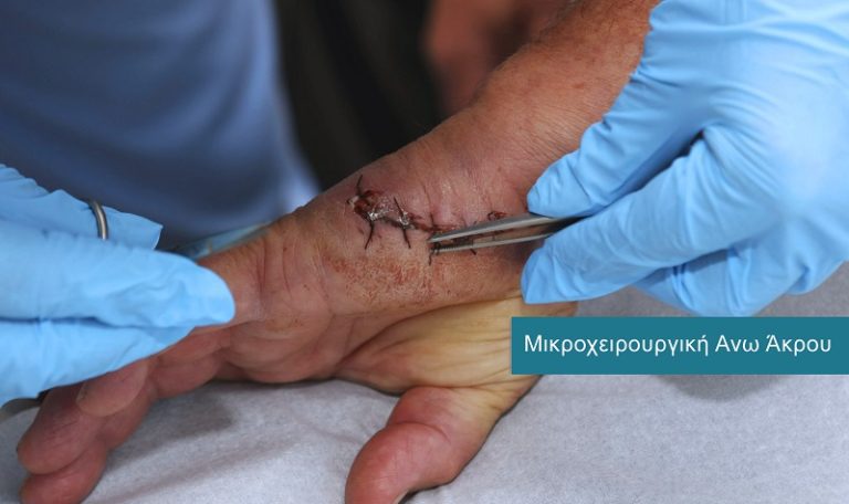 Μικροχειρουργική - Άνω Άκρου Μικροχειρουργική - Άνω Άκρου